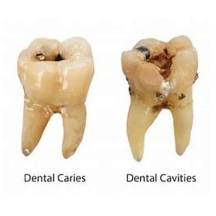 Other Cavities