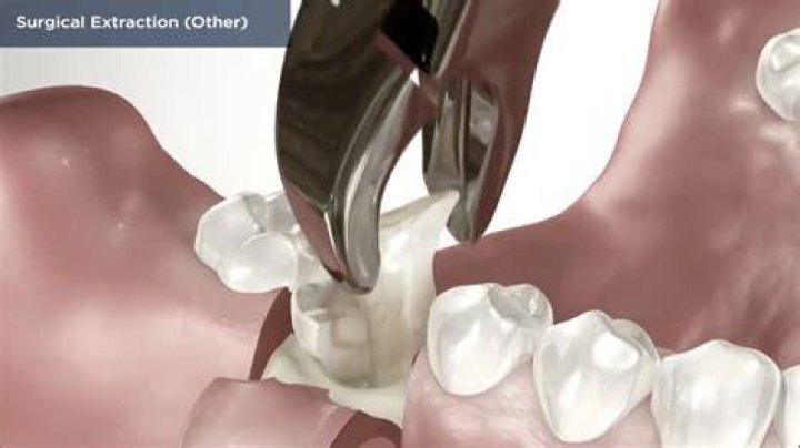 Surgical Extraction
